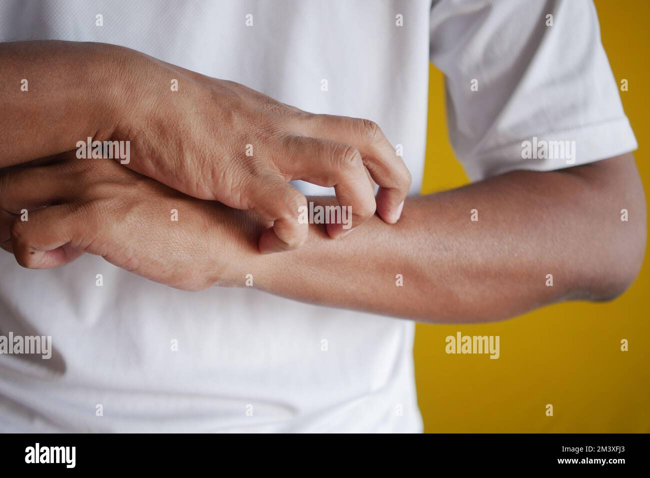 Itch rash hi-res stock photography and images - Alamy