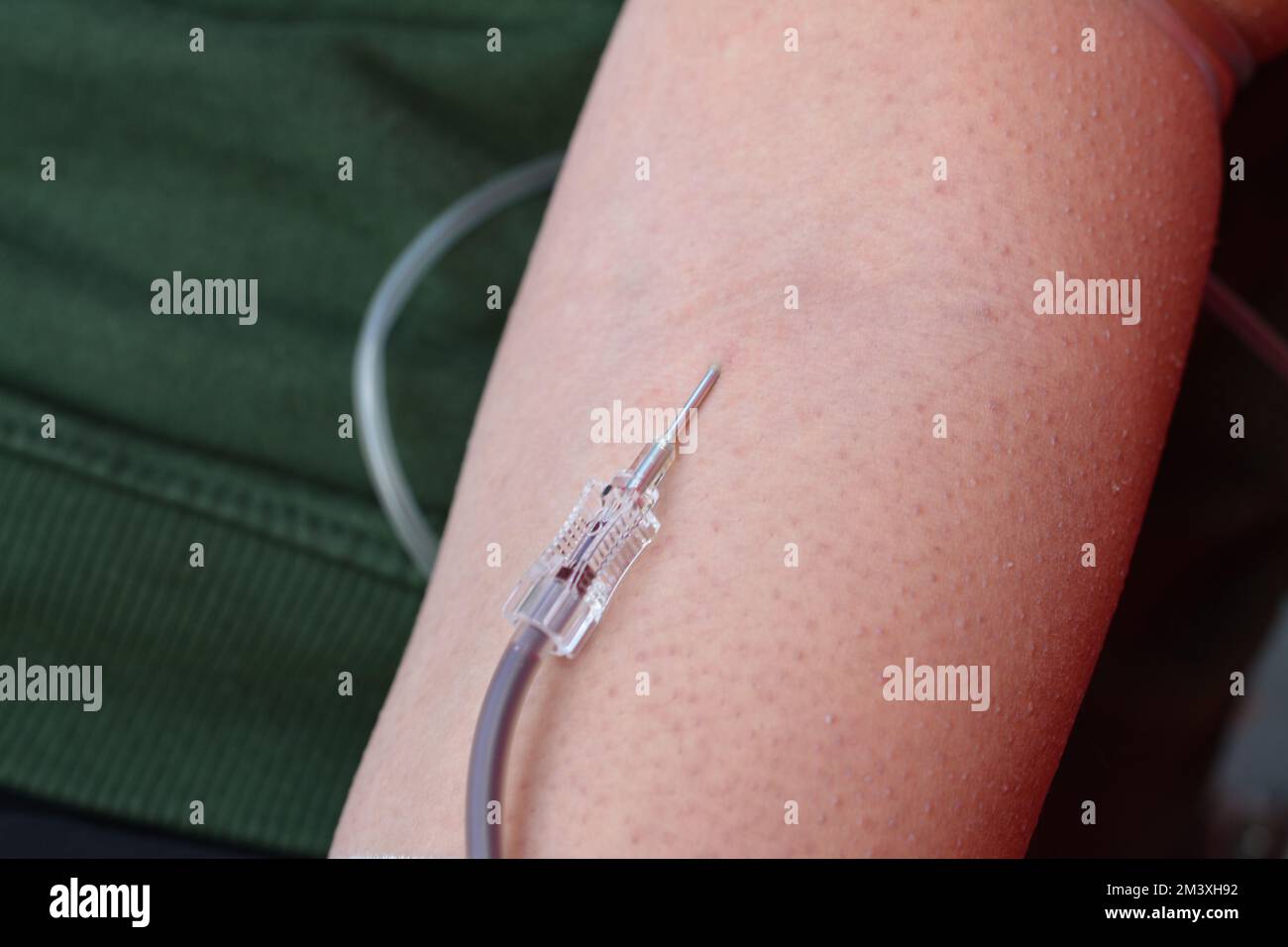 Blood donation, a blood donor volunteer with and intravenous line collecting a blood bag for charity and children with thalassemia and other diseases, Stock Photo