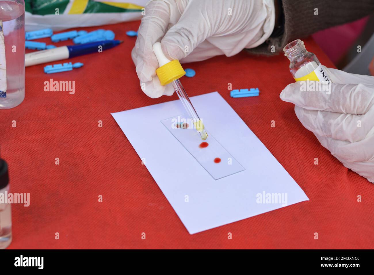 Cairo, Egypt, December 15 2022: ABO blood typing for checking the blood ...