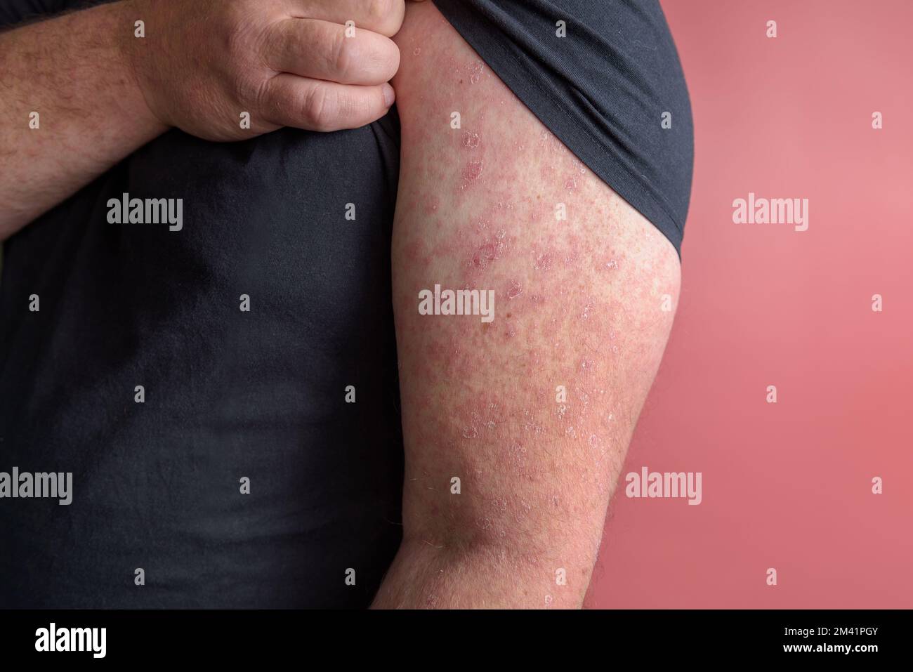 Erysipelas Red rash appears on the forearm. Close up Stock Photo