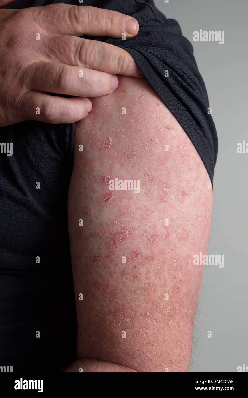 A red rash on the forearm. Erysipelas. Hand afflicted вermatophytosis on skin. Stock Photo