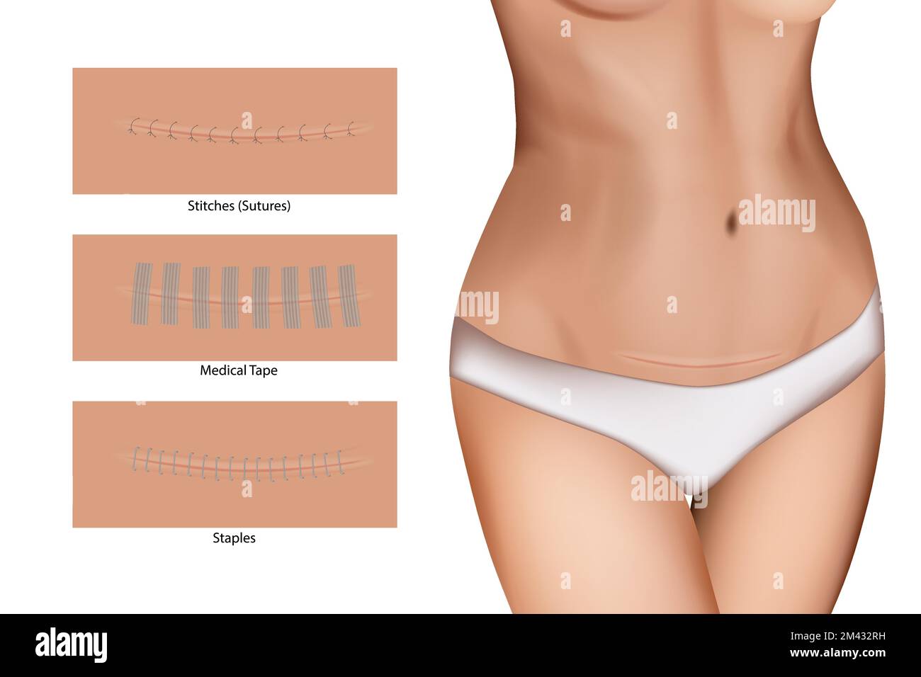 Closeup of incision with sutures. Wound closure devices Staples, Medical Tape and Stitches (Sutures). Stock Vector
