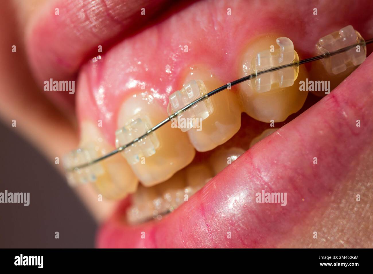 Close-up of young woman mouth, fixed braces with ceramic brackets Stock Photo