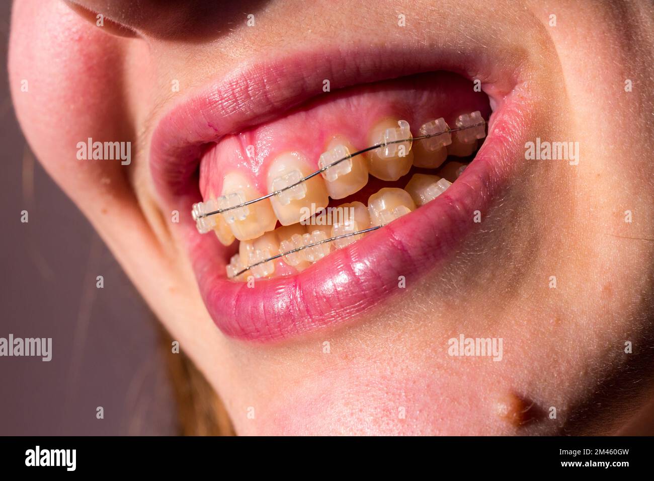 Close-up of young woman mouth, fixed braces with ceramic brackets Stock Photo