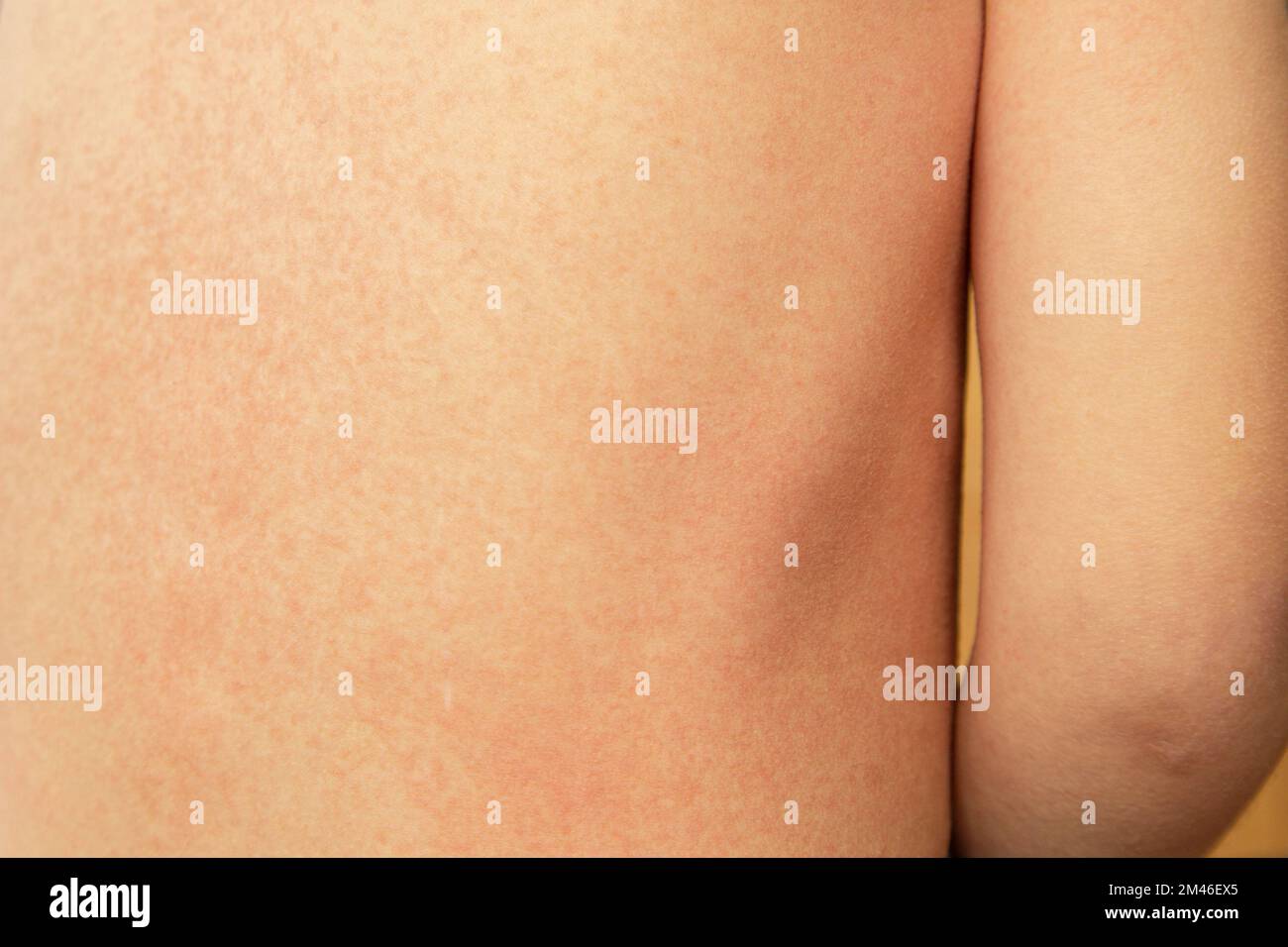 Rash on the back of a small child with scarlet fever caused by group A streptococcus Stock Photo