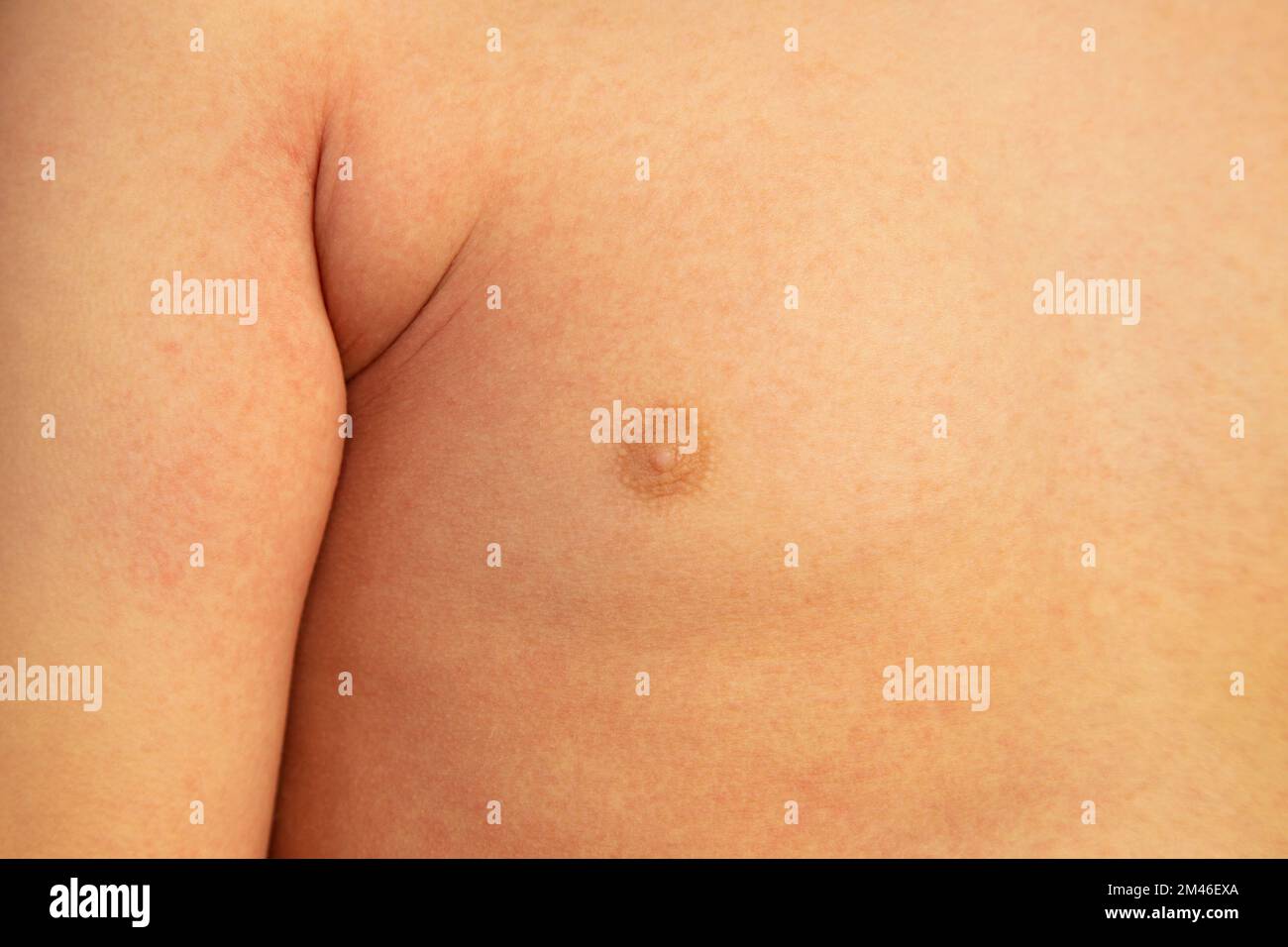 Rash on the chest of a small child with scarlet fever caused by group A streptococcus Stock Photo