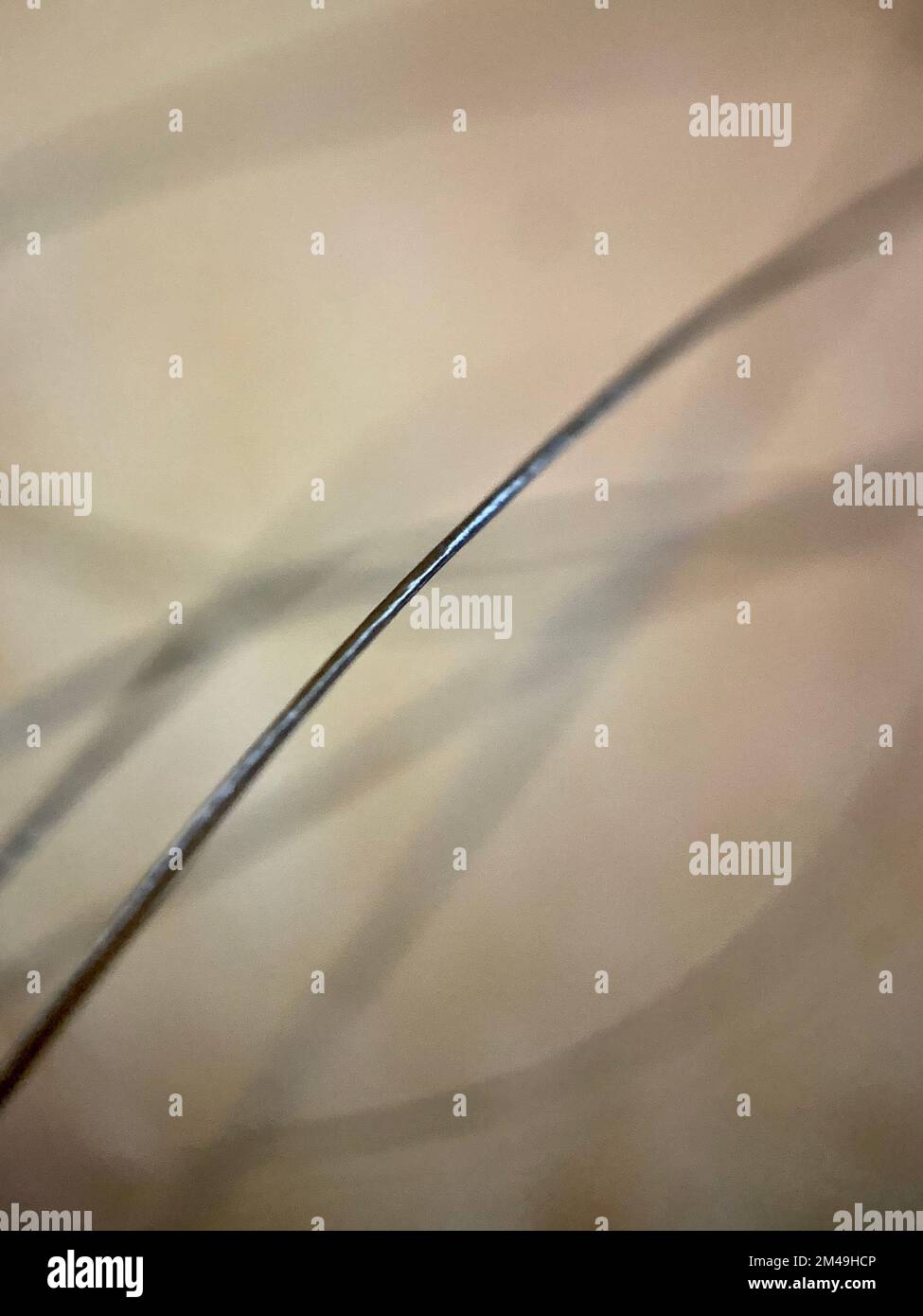 Concept of hereditary baldness alopecia and 5alpha