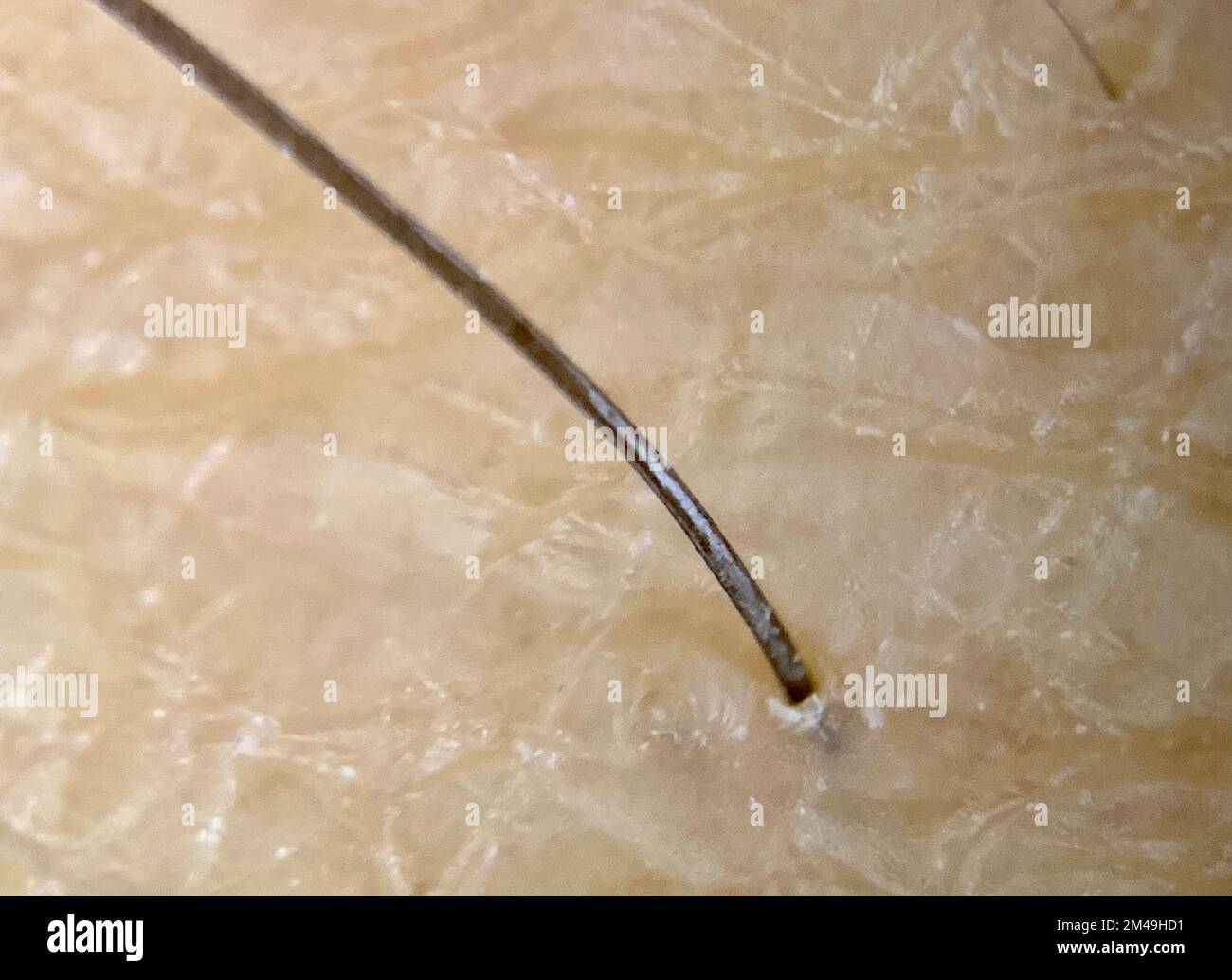 Concept of hereditary baldness androgenetic alopecia and 5-alpha reductase: Close up detail of a human hair coming out of the epidermis. transplanted Stock Photo