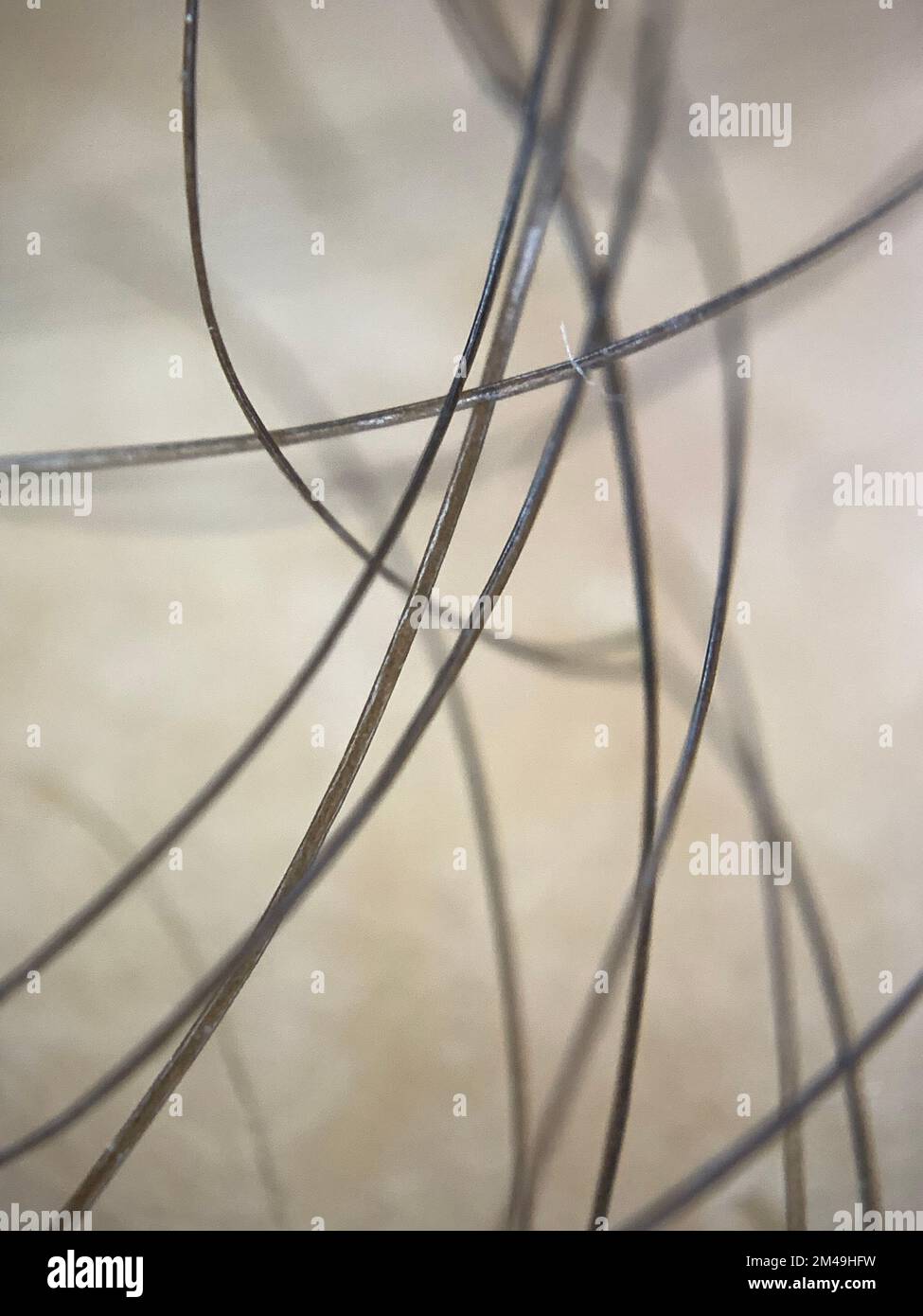 Concept of hereditary baldness alopecia and 5alpha