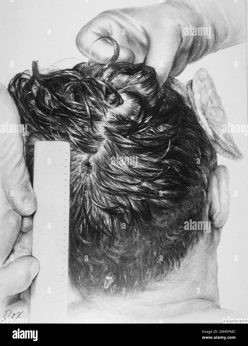 Drawing depicting the posterior head wound of U.S. President John F. Kennedy. The hand at the top is holding a portion of his scalp in place. Made by medical illustrator Ida G. Dox from an autopsy photograph, Stock Photo