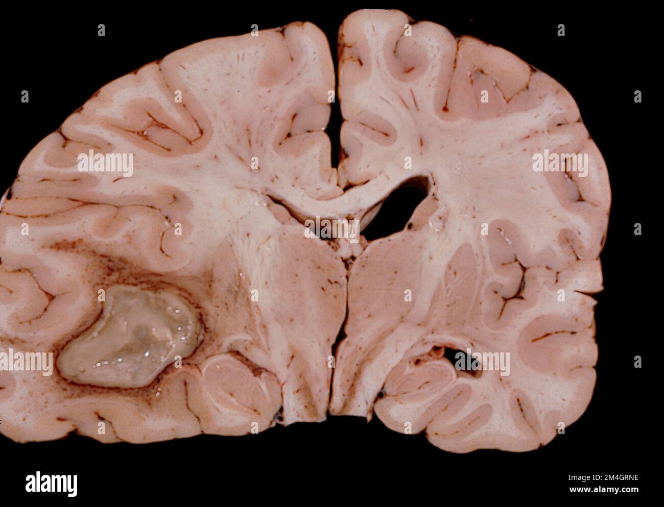 Coronal section through a human brain at the thalamus level showing a large abscess, probably of bacterial origin, located in the temporal lobe. The g Stock Photo