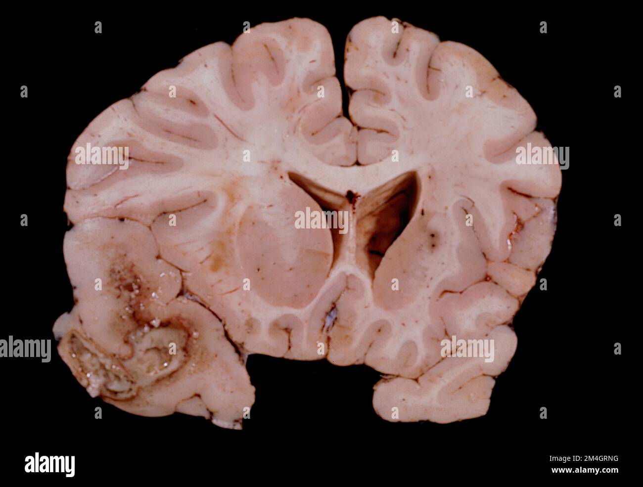 Coronal section through a human brain at the thalamus level showing a large abscess, probably of bacterial origin, located in the temporal lobe. The g Stock Photo