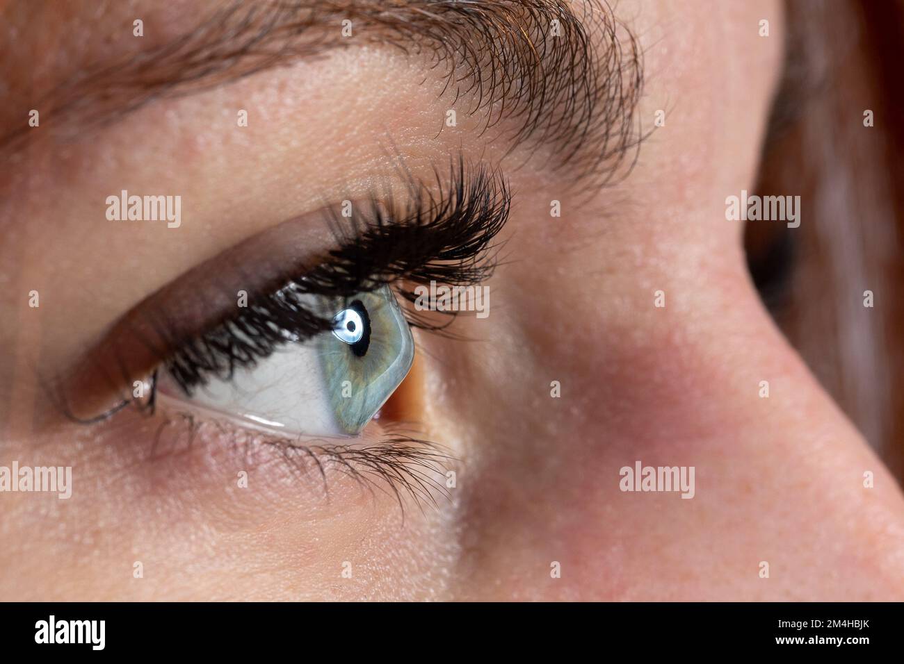 Human eye of a woman affected by keratoconus, or conical cornea. Vision pathology leading to myopia and astigmatism and severe visual aberrations. Tre Stock Photo