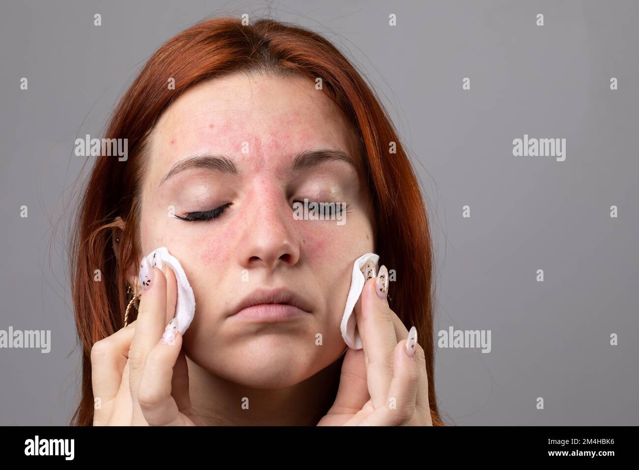 Caucasian girl taking off her makeup with make-up remover wipes. Facial redness due to nickel allergy contained in cosmetic products. Allergy and urti Stock Photo