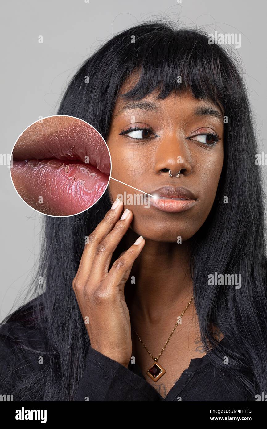 Young African girl with dry chapped lips. Magnifying circle showing dry