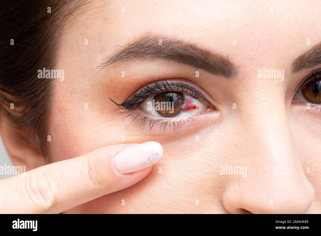 Primopian of the face of a young woman showing with the finger of the hand the subconjunctival hemorrhage. Red eye due to the breakdown of a capillary Stock Photo