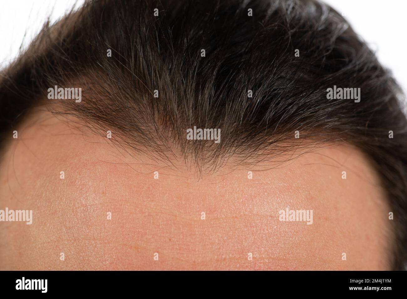 Premature balding hi-res stock photography and images - Alamy