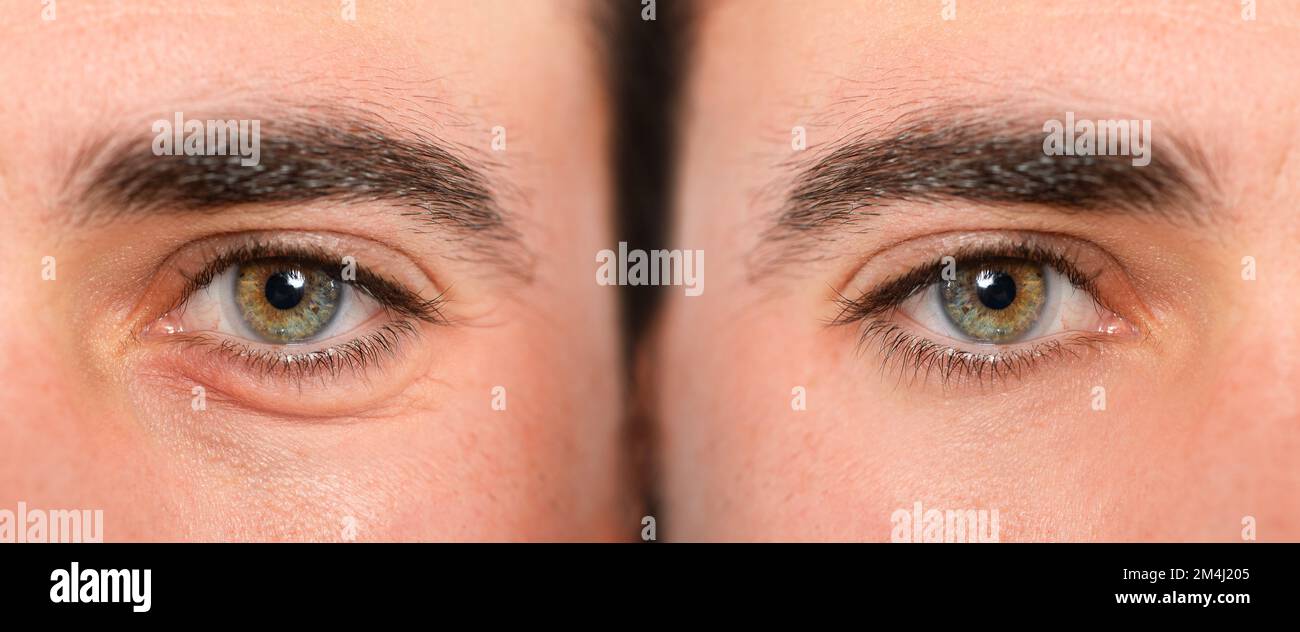 Eyes of woman with and without eye bag before and after cosmetic