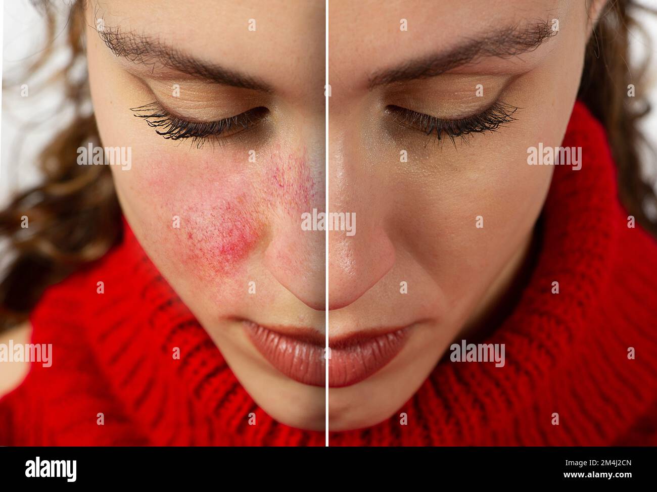 A close up view on the cheeks of a young Caucasian woman suffering from