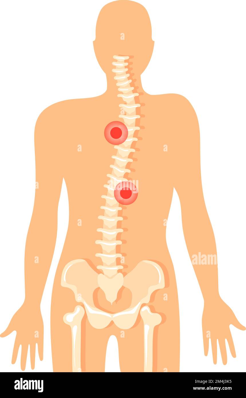 Backbone pain. Spine ache icon. Vertebral column diagram isolated on ...