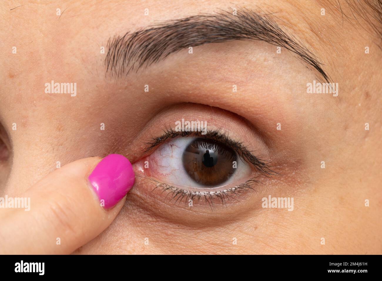 Macro of woman's eye with red capillaries. Finger indicating redness. Concept of allergy and conjunctivitis Stock Photo
