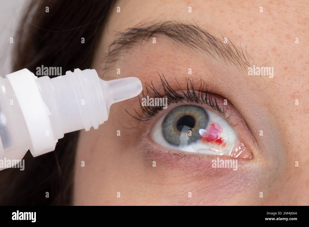 Primopian of a woman's eye with subcontractive hemorrhage that is given the eye drops. Red eye for the breakdown of capillaries due to cough or sternu Stock Photo