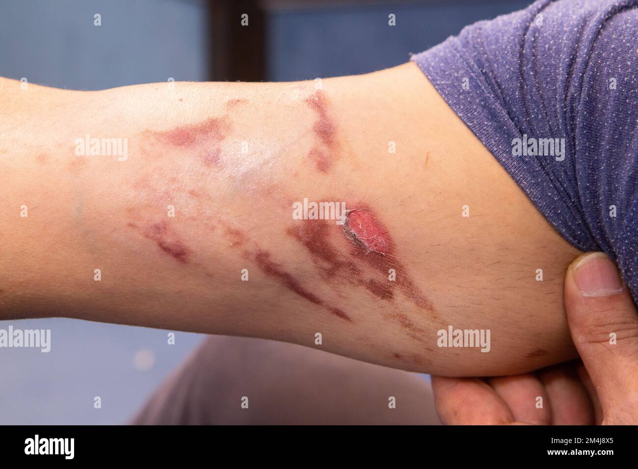 accident at work, skin on the arm burned by corrosive substances and