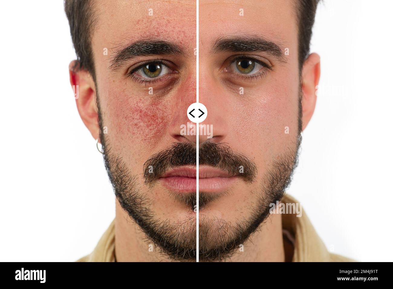Caucasian male face with red skin rosacea before and after couperose treatment Stock Photo