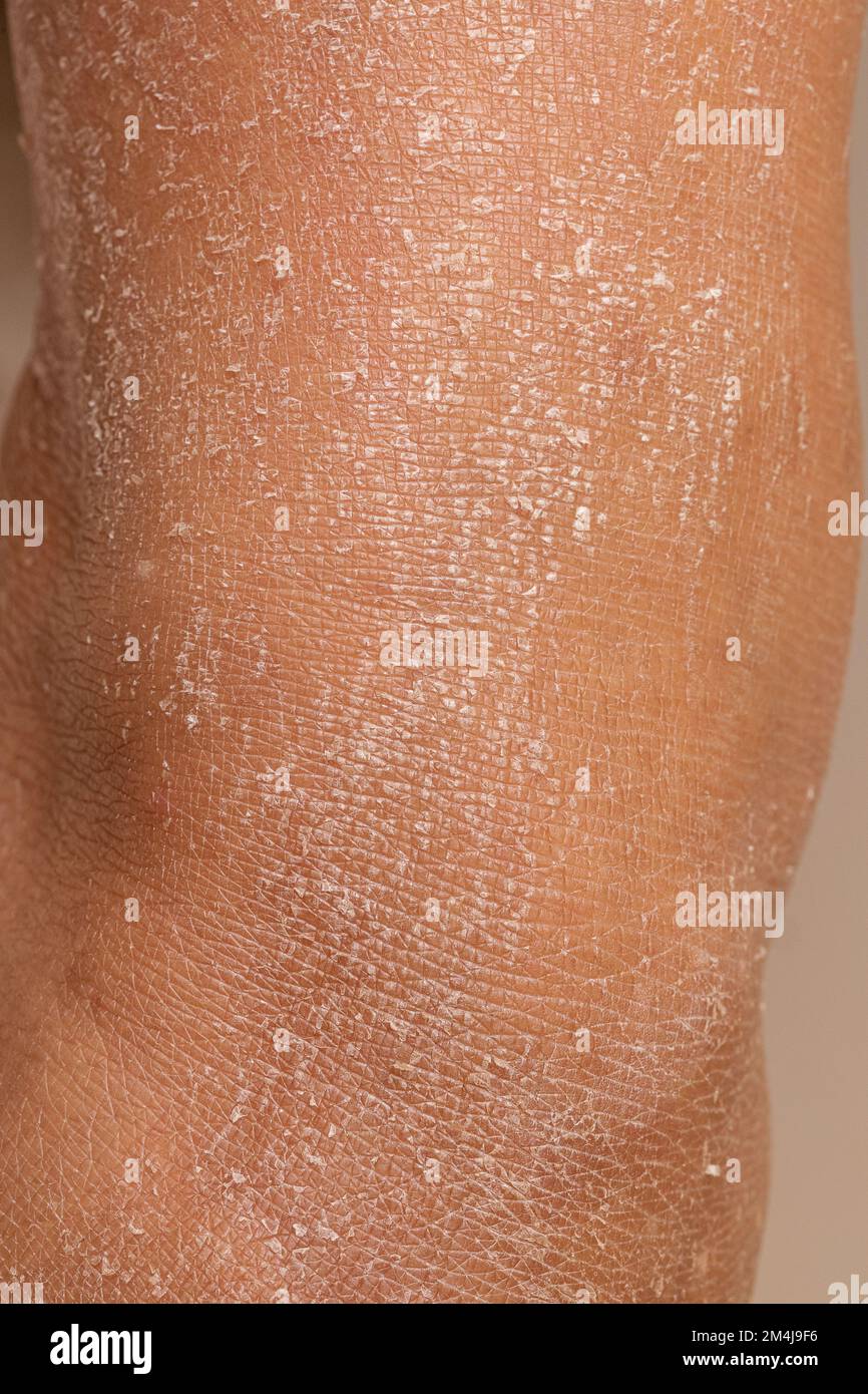 Woman leg with dry skin and dehydration problems. Marked skin exfoliation Stock Photo Alamy