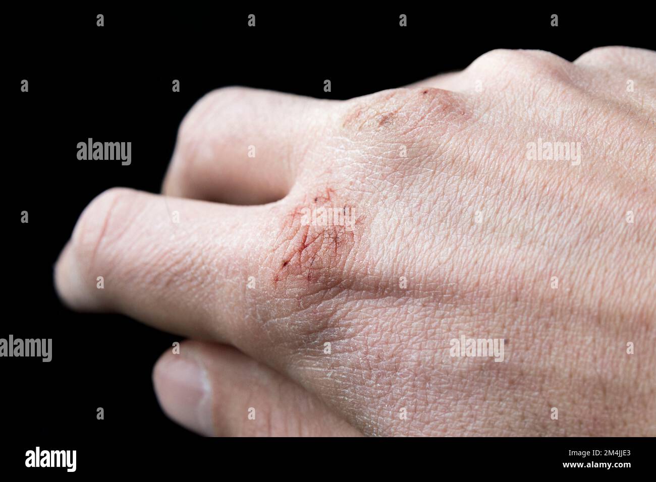 Chapped hands from cold weather, dry cracked knuckles Stock Photo Alamy