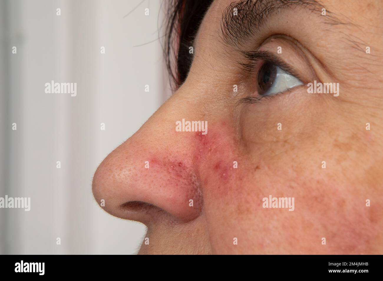 Womans Face With Red Skin And Pustules Near The Nose Acne Rosacea