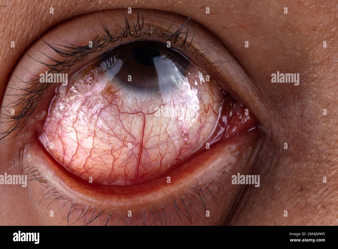 Human eye red, evident irritation of the capillaries due to conjunctivitis and eyelid herpes Stock Photo