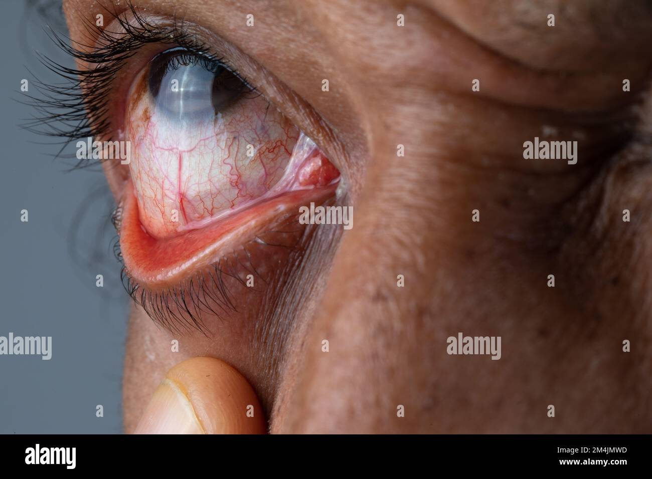 Macro of a red African man's eye, evident irritation of the capillaries due to conjunctivitis and widespread redness over the entire conjunctiva Stock Photo