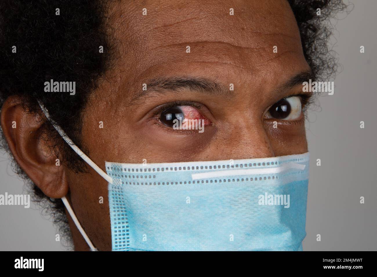 Portrait of African man showing a red eye, concept of one of the symptoms of covid 19 Stock Photo