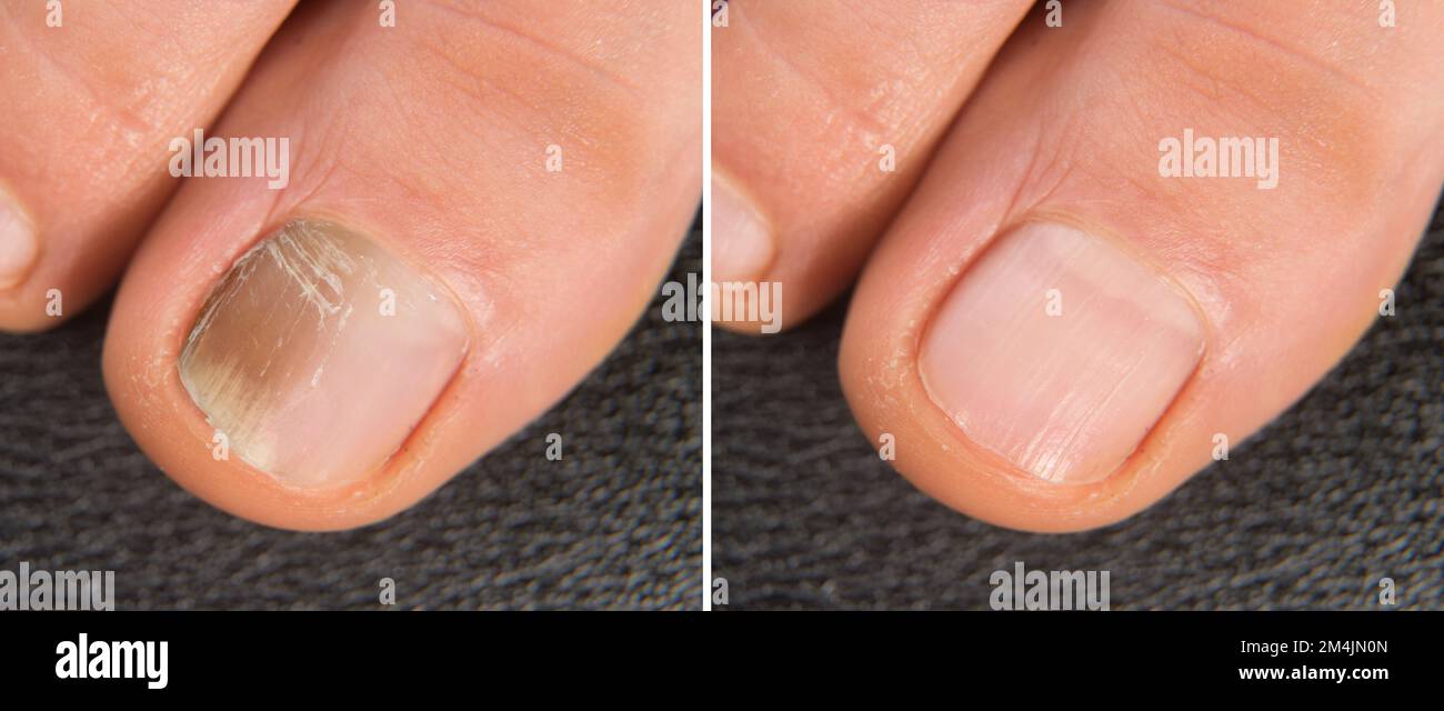 Formulation and Evaluation of Nail Lacquer of Clotrimazole for Treatment of  Onychomycosis | IJPPR