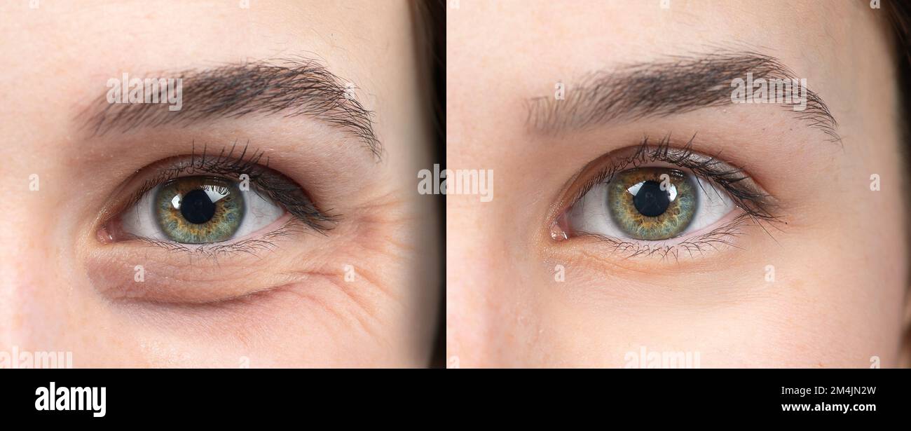 Woman eyes before and after an anti age treatment for wrinkles and crow's feet Stock Photo