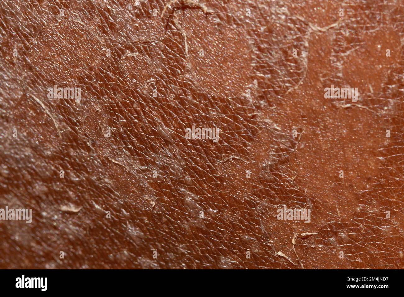 Details of skin that is peeling from sunburn Stock Photo