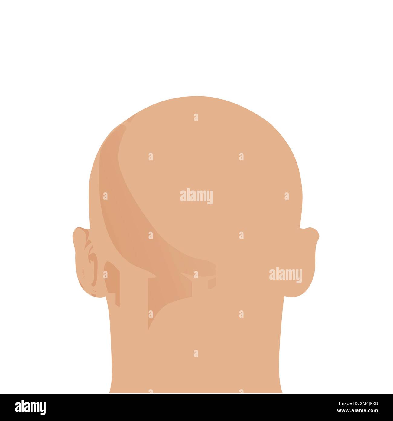 Hair loss. Stages of alopecia man problem vector medical health