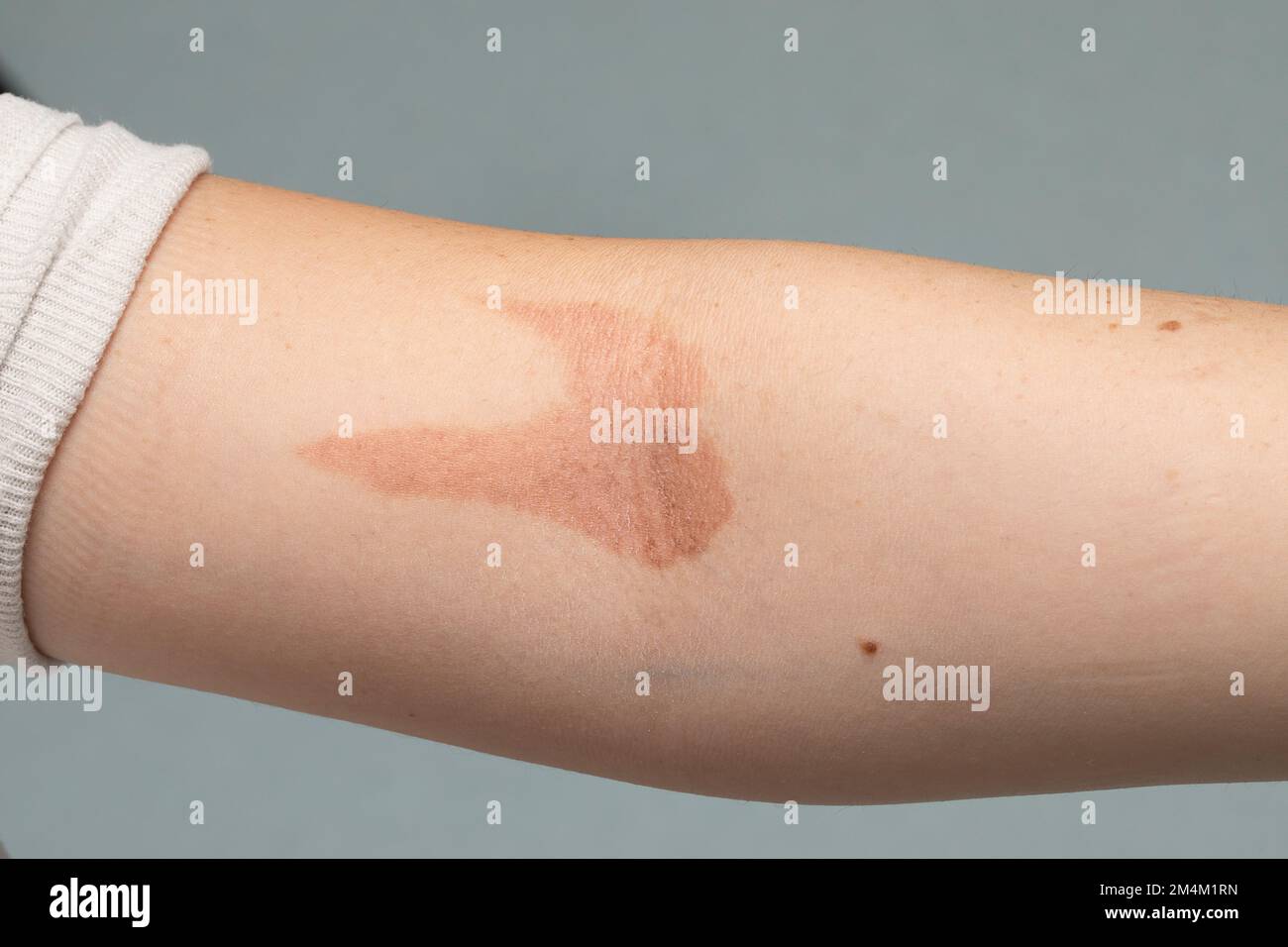 Sunspot on a girl's arm, details of a skin rash due to sunburn. Concept of danger from excessive