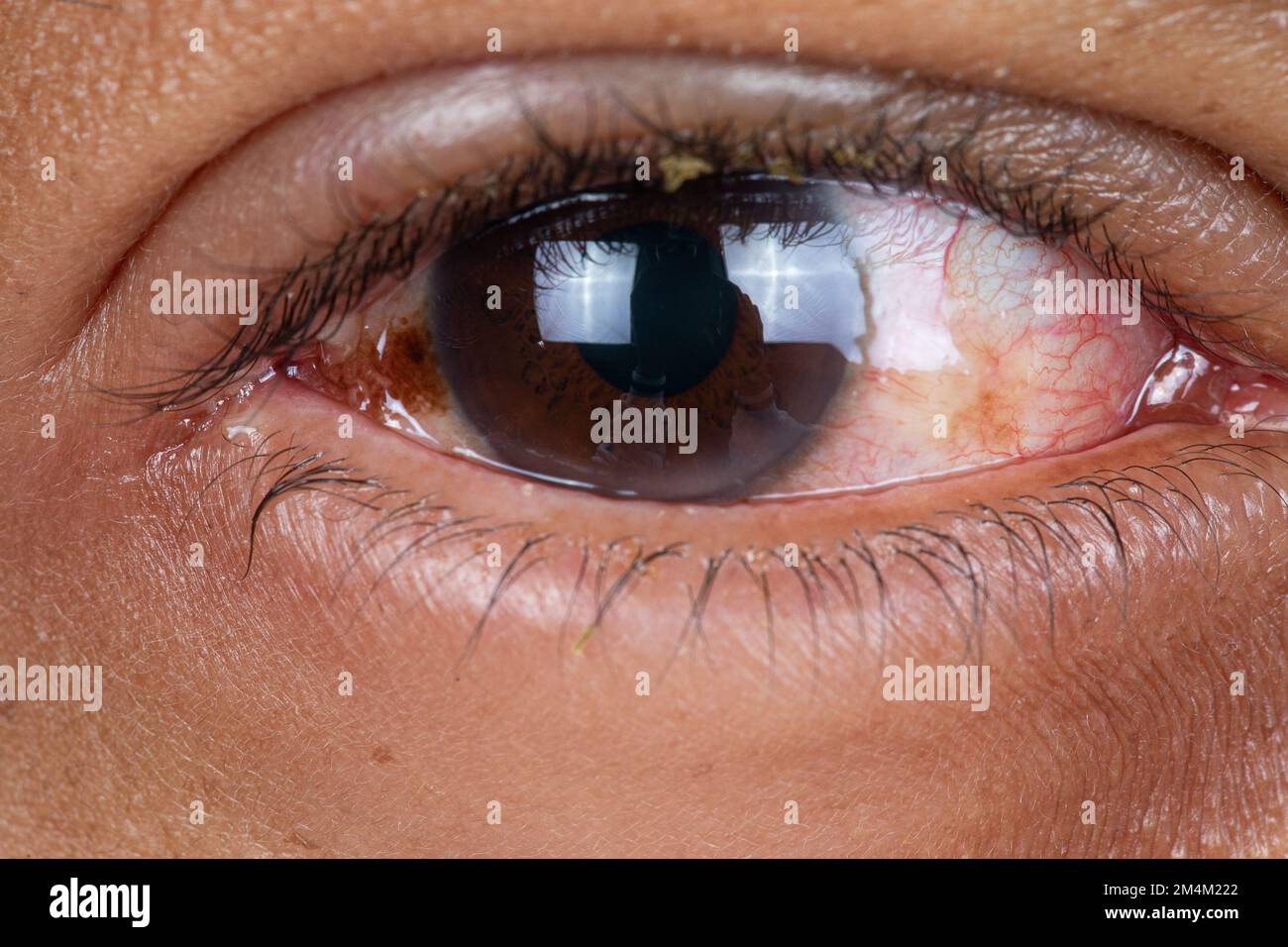Rovigo, ITALY - October 16, 2020: Red eye of african man with conjunctivitis due to pollen allergy, details of redness of the capillaries and dry puru Stock Photo