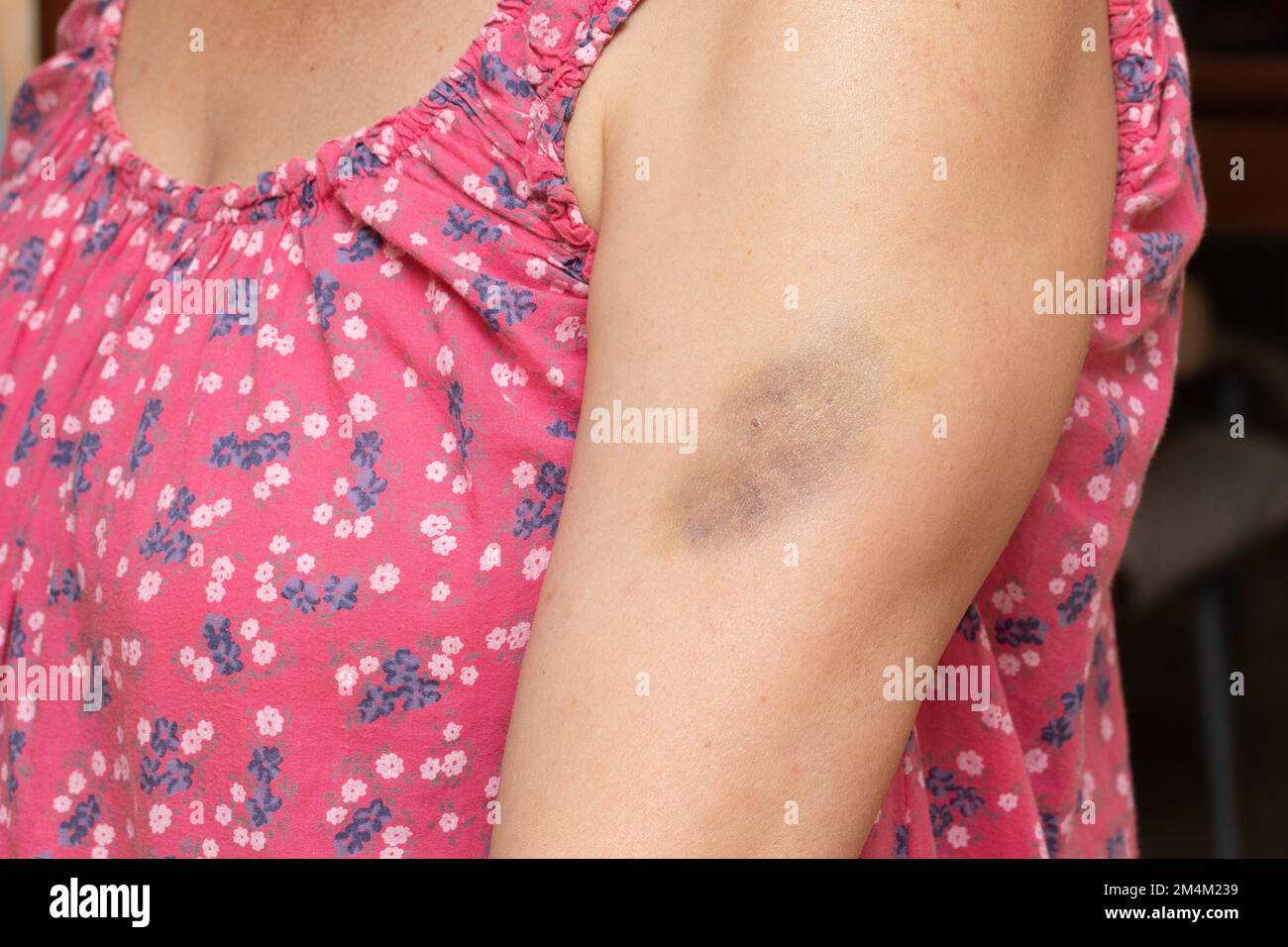 Bruise on a woman s arm hematoma symptom of fragile capillaries and