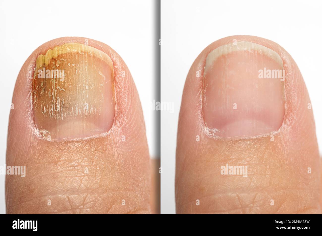 How to Treat Toenail Fungus: Effective Remedies & Prevention