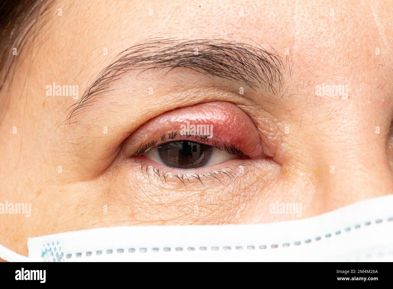 Closeup of an eye with chalazion, details of the face of a mature woman sad about her swollen eye with red eyelid due to conjunctivitis and bacterial Stock Photo