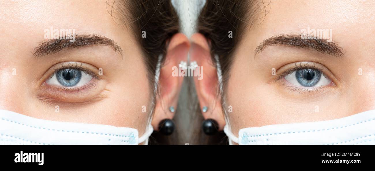 Close up of eye bags before and after cosmetic treatment. Comparison of