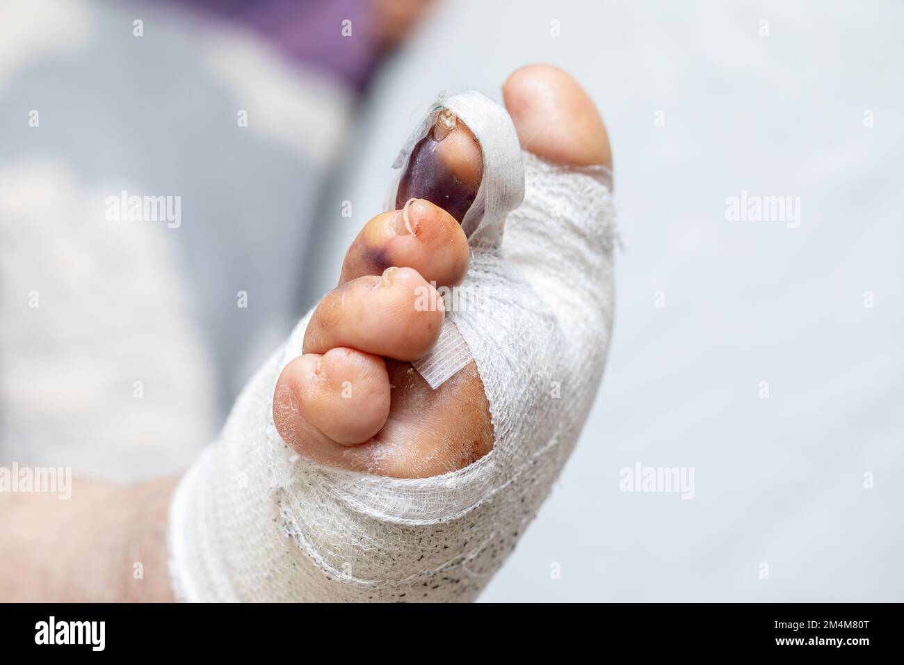 Closeup of a foot after corrective surgery for hallux valgus, narrow faces to keep the toes in