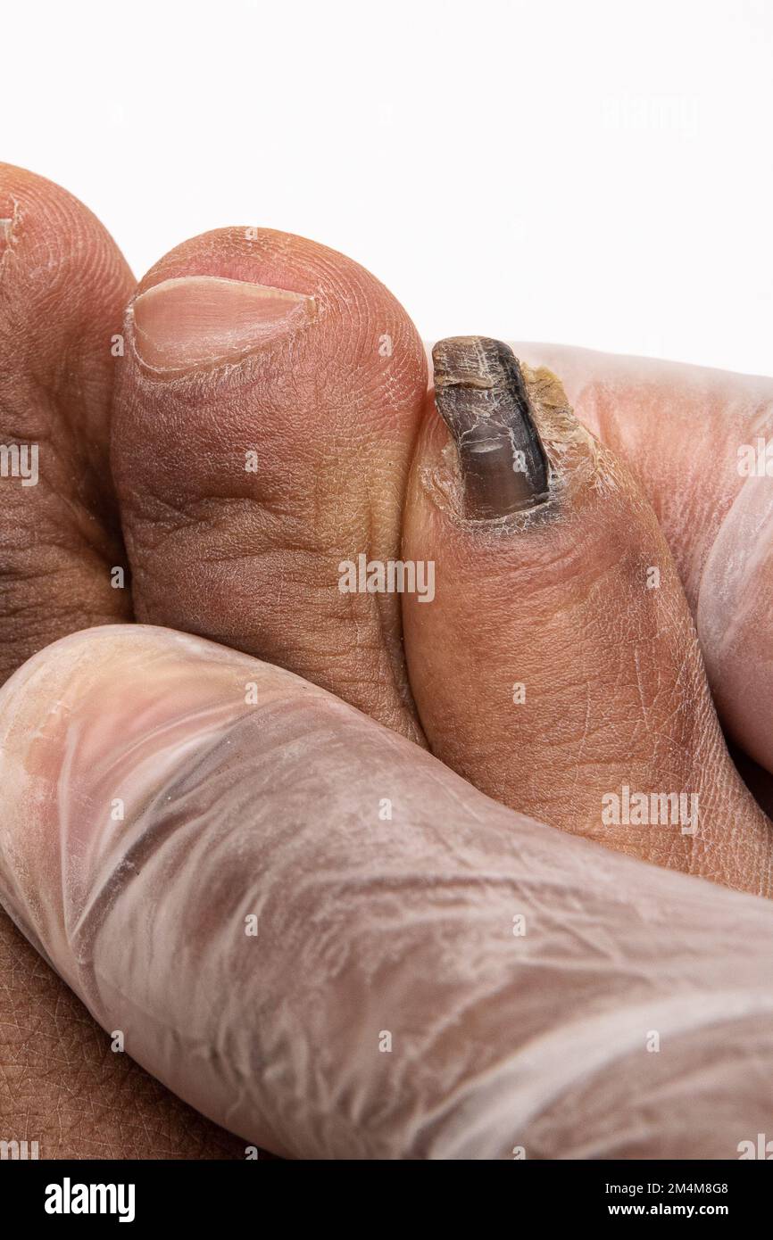 Macro of a toe of an African man suffering from onychomycosis, a fungal infection on the nail that caused hyperkeratosis. Inspection by the dermatolog Stock Photo