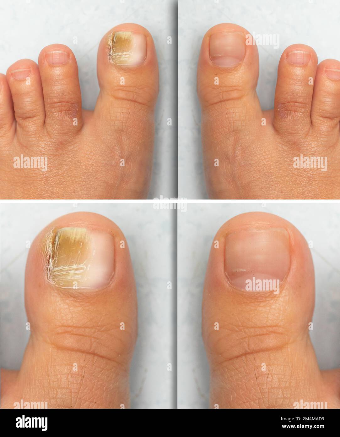 Before and after successful mycosis treatment on the big toe of an