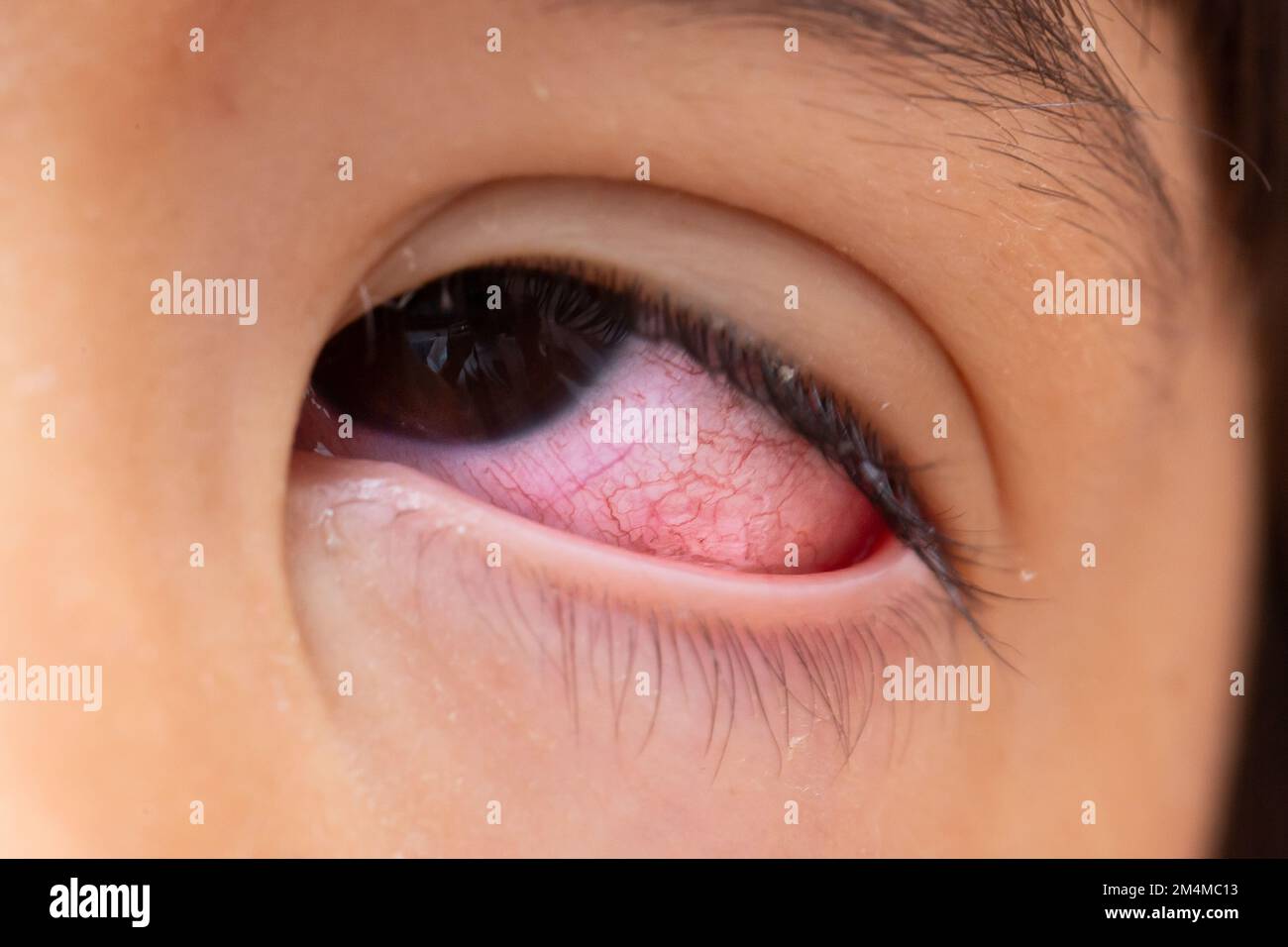 Macro of a very red eye with oriental features due to conjunctivitis. Dryness and redness of the sclera due to irritation Stock Photo