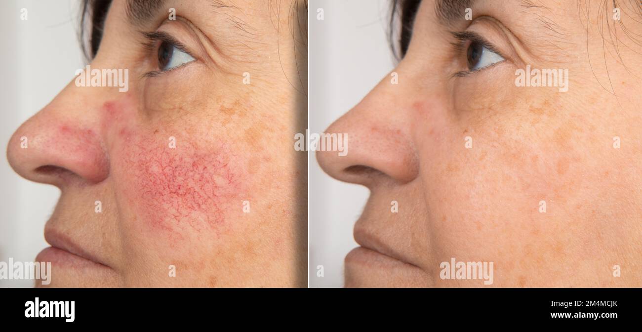 A close-up portrait of before and after a mature woman showing redness on her cheeks. The concept of rosacea. High quality photo Stock Photo
