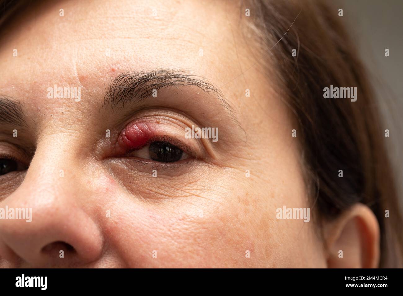 inflammation of the hair bulb on the eyelids, hordeolum, bacterial infection in the eyelid. High quality photo Stock Photo